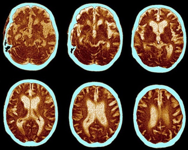 Social ties best weapon against Alzheimer's disease