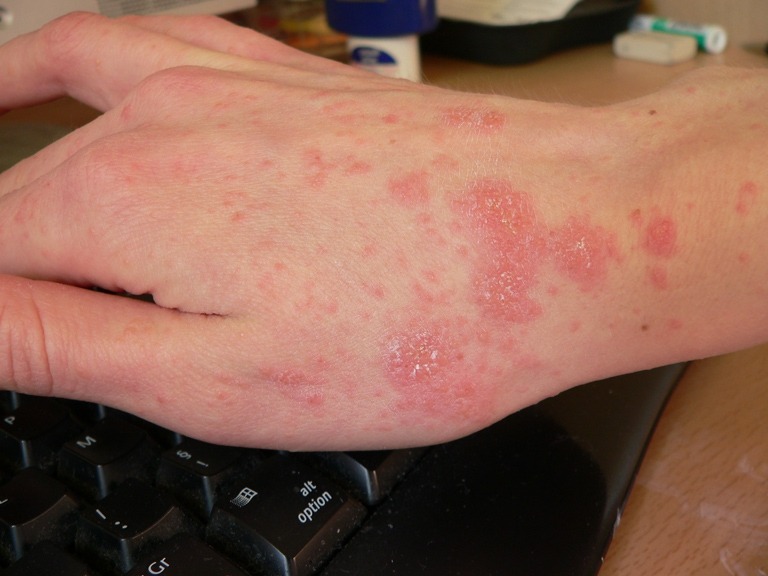 Outbreak of scabies at Stib depot – “minimal risk to public”