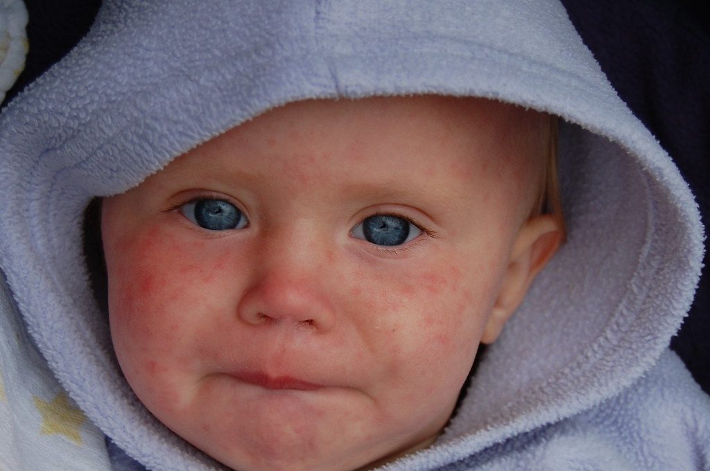 High Council for Health issues new measles vaccine advice