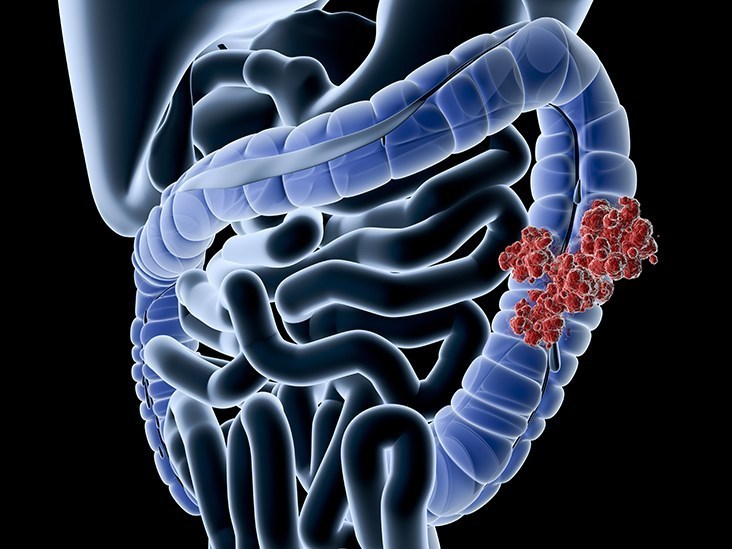 Liège researchers report breakthrough in colon cancer treatment