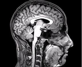 Even mild Covid patients could suffer serious brain damage, neurologists warn
