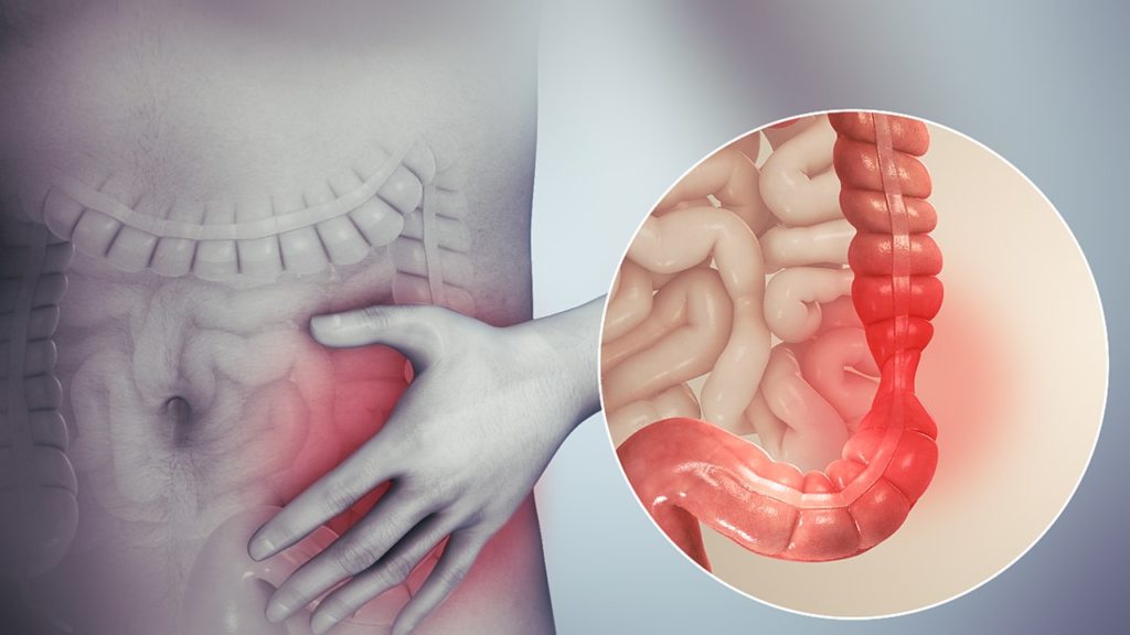 Leuven research suggests cause for irritable bowel syndrome