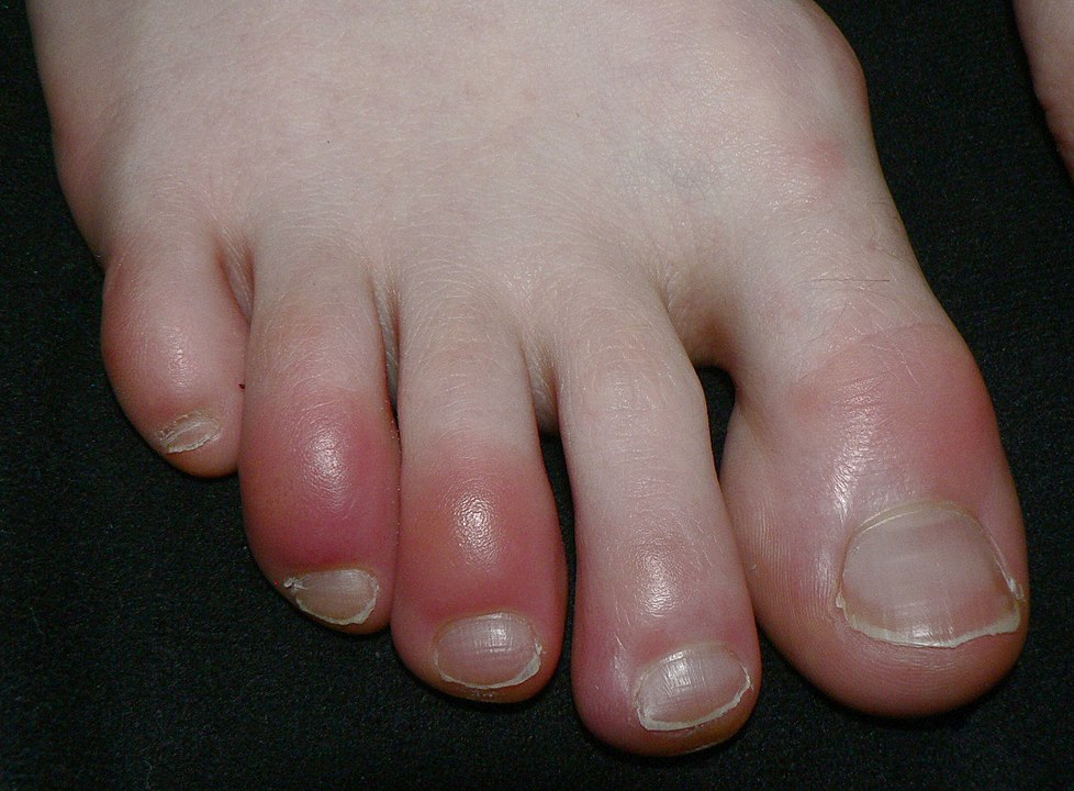 An epidemic of chilblains: Is there a link with Covid-19?
