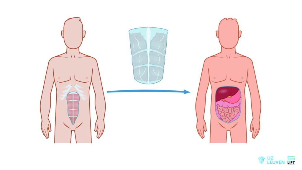 Belgium's first abdominal wall transplant a success