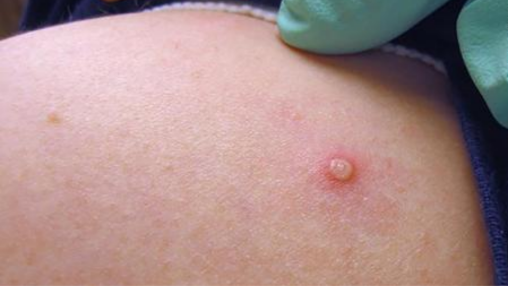 168 Monkeypox cases confirmed in Belgium