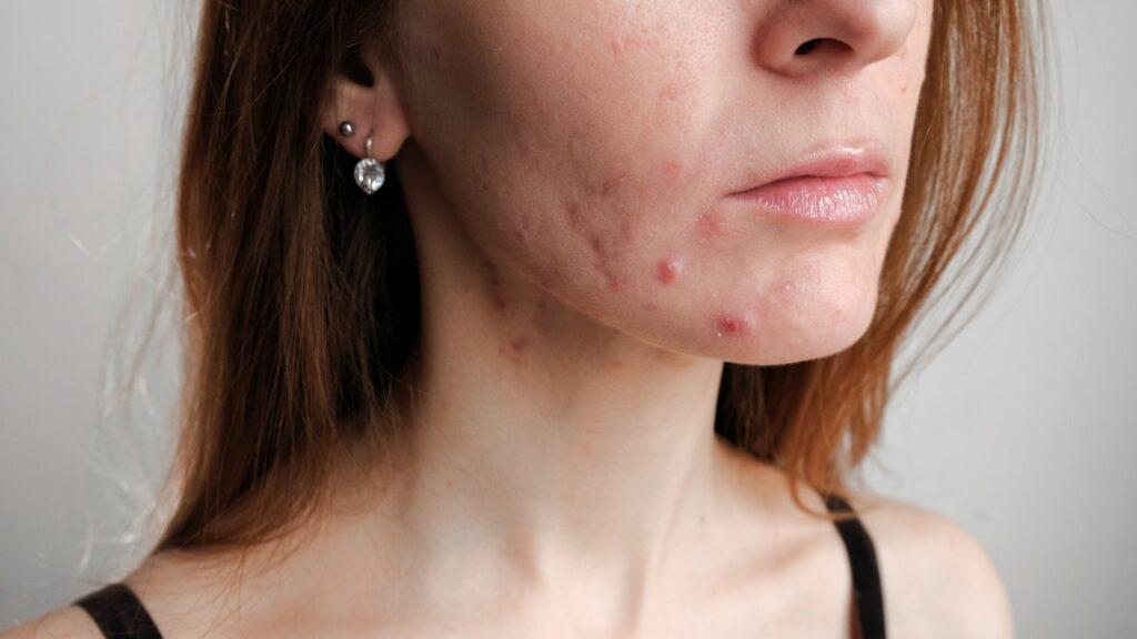 Adult acne on the rise in Belgium, according to leading dermatologists