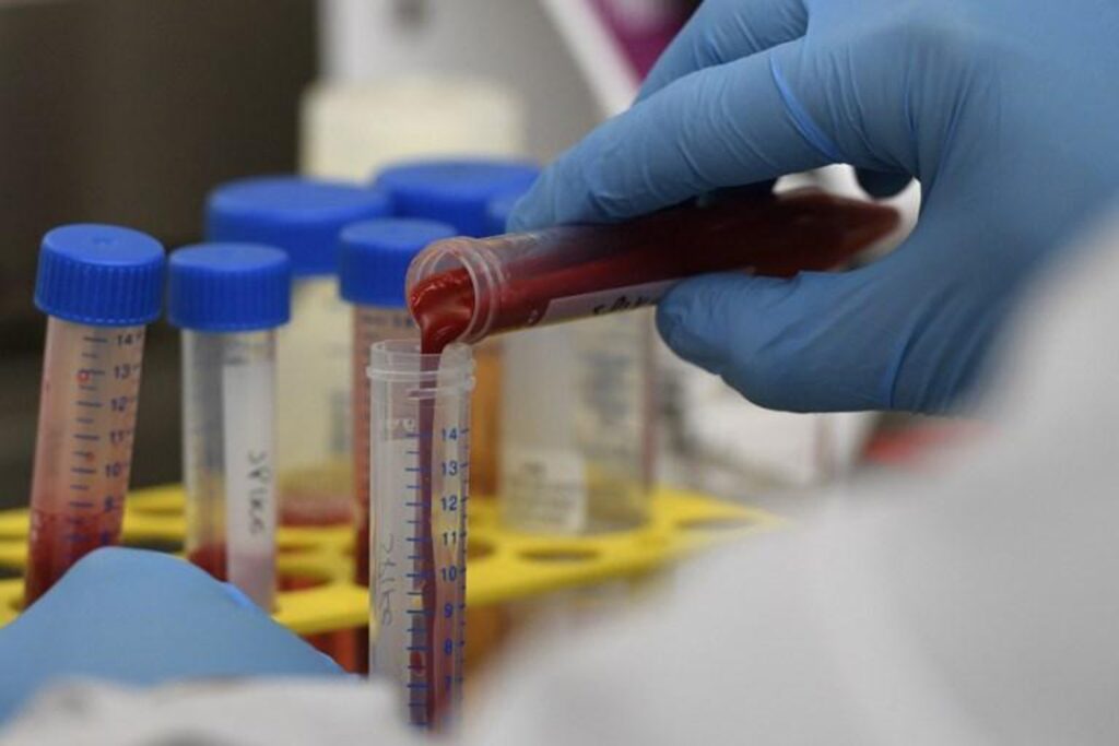 New blood test detects cirrhosis earlier in obese people
