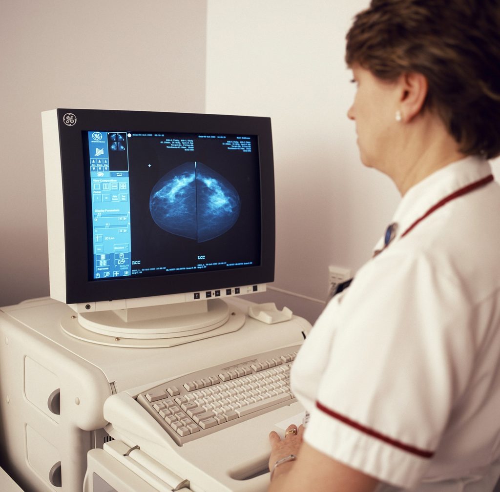 AI could help radiologists screen for breast cancer, study suggests