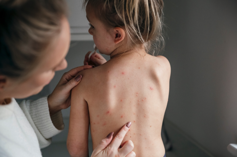 Children with chickenpox allowed to still attend school from now on