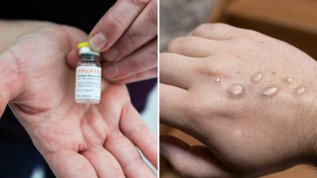 'Expect the unexpected': How is Belgium preparing for deadlier mpox variant