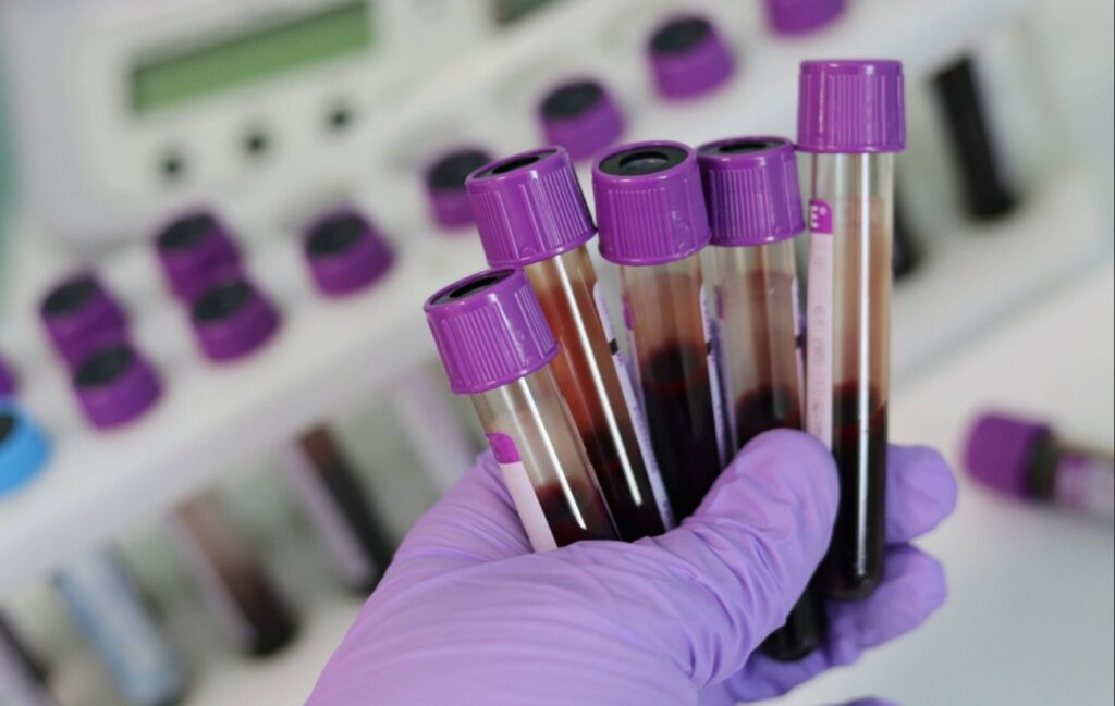 Why HIV is three times more prevalent in Brussels than in the rest of Belgium