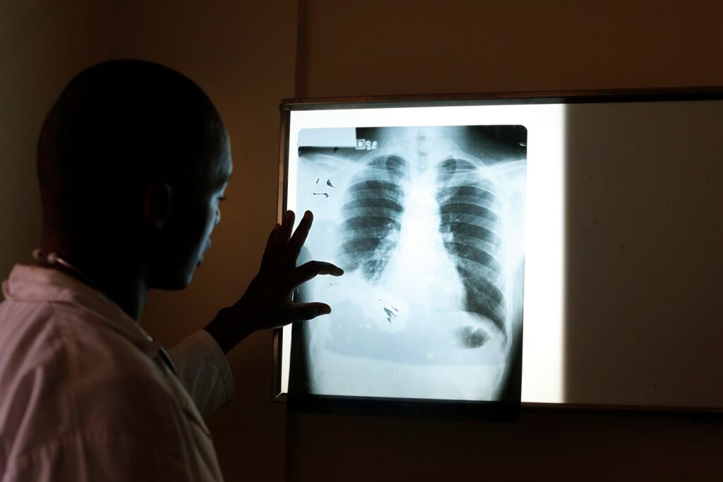 Tuberculosis cases in Brussels three times higher than Belgian average