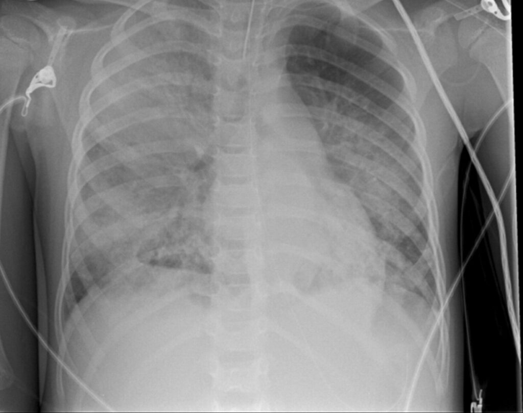 Pneumococcal infections hit new record in 2025