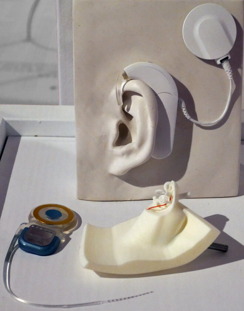 Austrian company presents invisible hearing implant at Antwerp Hospital