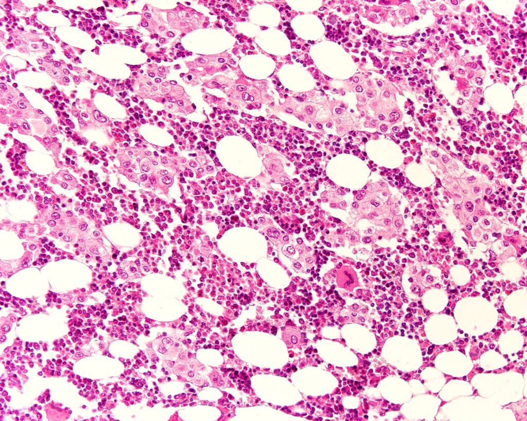 Belgian researchers aims to improve understanding of breast cancer metastases